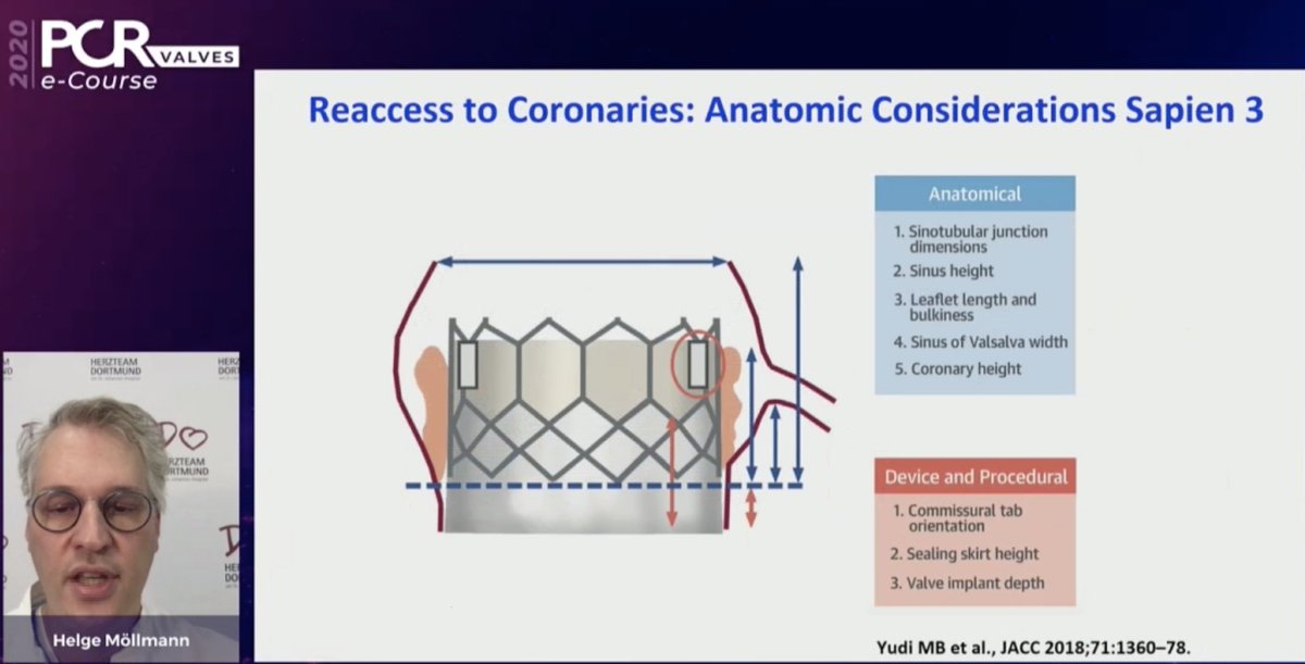 mirvatalasnag's tweet photo. #PCRValves @PCRonline @didier_tchetche @CuissetDr @GilbertTangMD @modine_thomas @DrMoritzWvB
Considerations:
⏫10% will develop ACS in 2 yrs
⏫Valve design & height of implant
⏫ViV different considerations
#REACCESS #ALIGNTAVR https://t.co/Dm9hFI64Ud