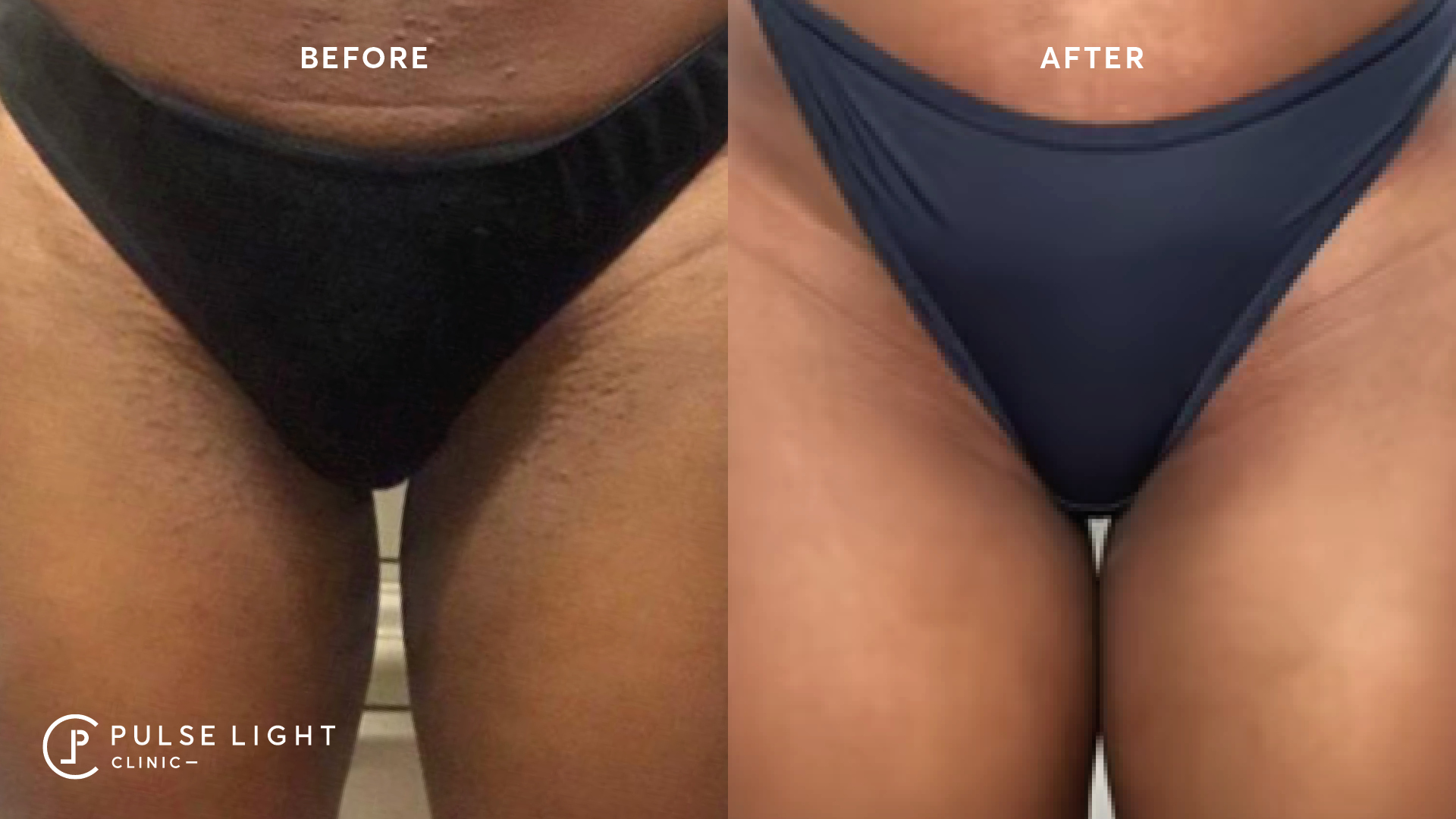 Pulse Light Clinic sur Twitter : "Our client results: Before and after laser hair removal treatments for ingrown hairs and PCOS with an expert from home! - Schedule a phone consultation