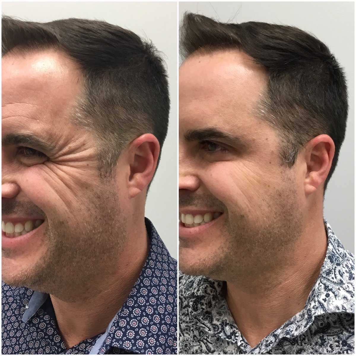 skinBeMedSpa's tweet photo. ʙʀᴏᴛᴏx ɪs ᴀ ᴛʜɪɴɢ! 🎯

Check out these unbelievable results on this client. Even the static lines have diminished after JUST ᴏɴᴇ ᴛʀᴇᴀᴛᴍᴇɴᴛ! 

Both women AND men can benefit from neuromodulator treatments to help reverse the signs of aging. #brotox #botox #antiaging https://t.co/kNTU0s8SRr
