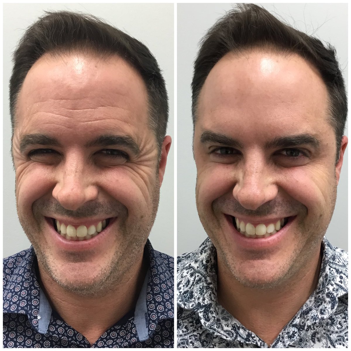 skinBeMedSpa's tweet photo. ʙʀᴏᴛᴏx ɪs ᴀ ᴛʜɪɴɢ! 🎯

Check out these unbelievable results on this client. Even the static lines have diminished after JUST ᴏɴᴇ ᴛʀᴇᴀᴛᴍᴇɴᴛ! 

Both women AND men can benefit from neuromodulator treatments to help reverse the signs of aging. #brotox #botox #antiaging https://t.co/kNTU0s8SRr