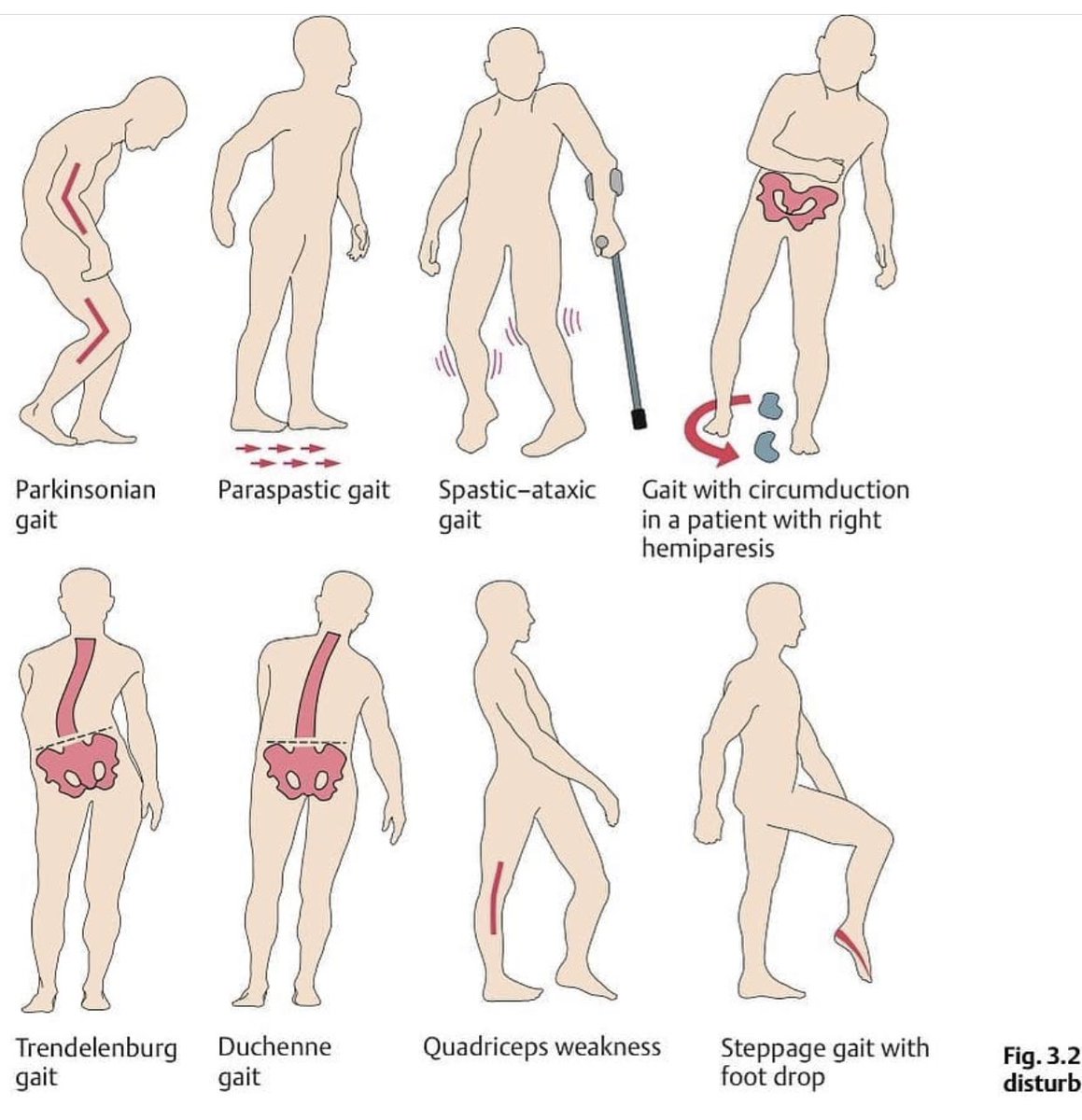 Azoz1450's tweet photo. 🔰 23/11/2020 🔰

🚷 Most common Gait impairment 🚷

- صورة رهيبة تختصر أشهر تشوهات المشي عند المرضى 👨🏻‍🦯🚶🏻‍♂️ 

⁉️ مين يقدر يسمي لنا اسباب التشوهات المذكورة 😬🙄🔥👏🏻 https://t.co/UsnxsyHk5r