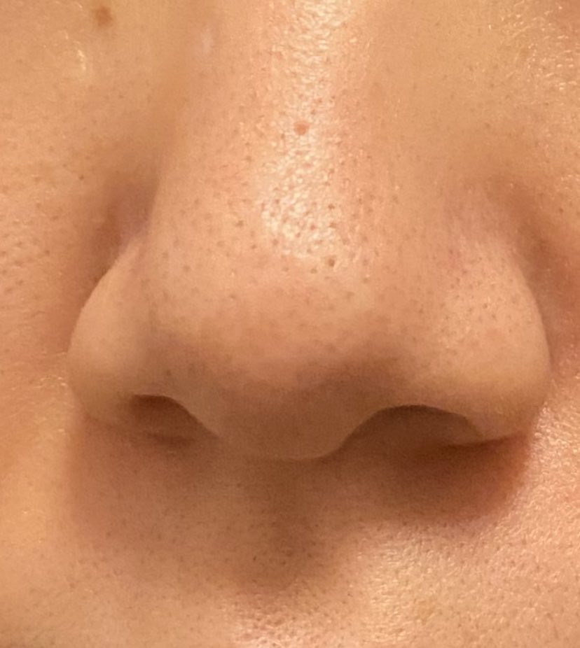 ট ইট র Mifu ダーマペン 筋トレ こんにちは ベビーオイル洗顔はじめて3ヶ月ほど経ちました 皮脂は落ち着いてきましたが なかなかいちご 鼻が治りません お風呂上がりは黒ずみがマシに見えます 産毛のせいか グリセリンのせいか両方なのかどのようにみえ