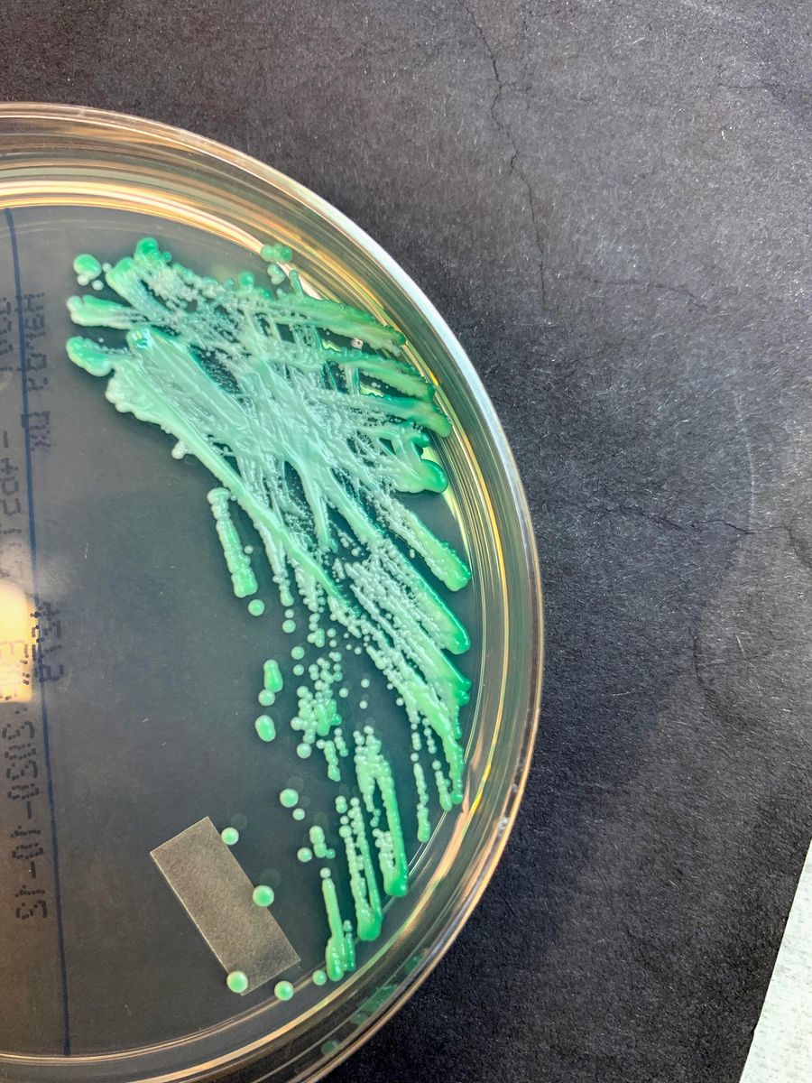 MGHPathology's tweet photo. This week's @MGHPathology Gross Pathology Roundup #MGHGPR is presented by Bianca Christensen, MD, MPH (@bbc_pathology).

⚕️ 78 year old with fungemia. A CHROMagar shows: 📸🧫

What is growing in this patient's blood culture⁉️ ⤵️🔬 https://t.co/byFsT6fzz6