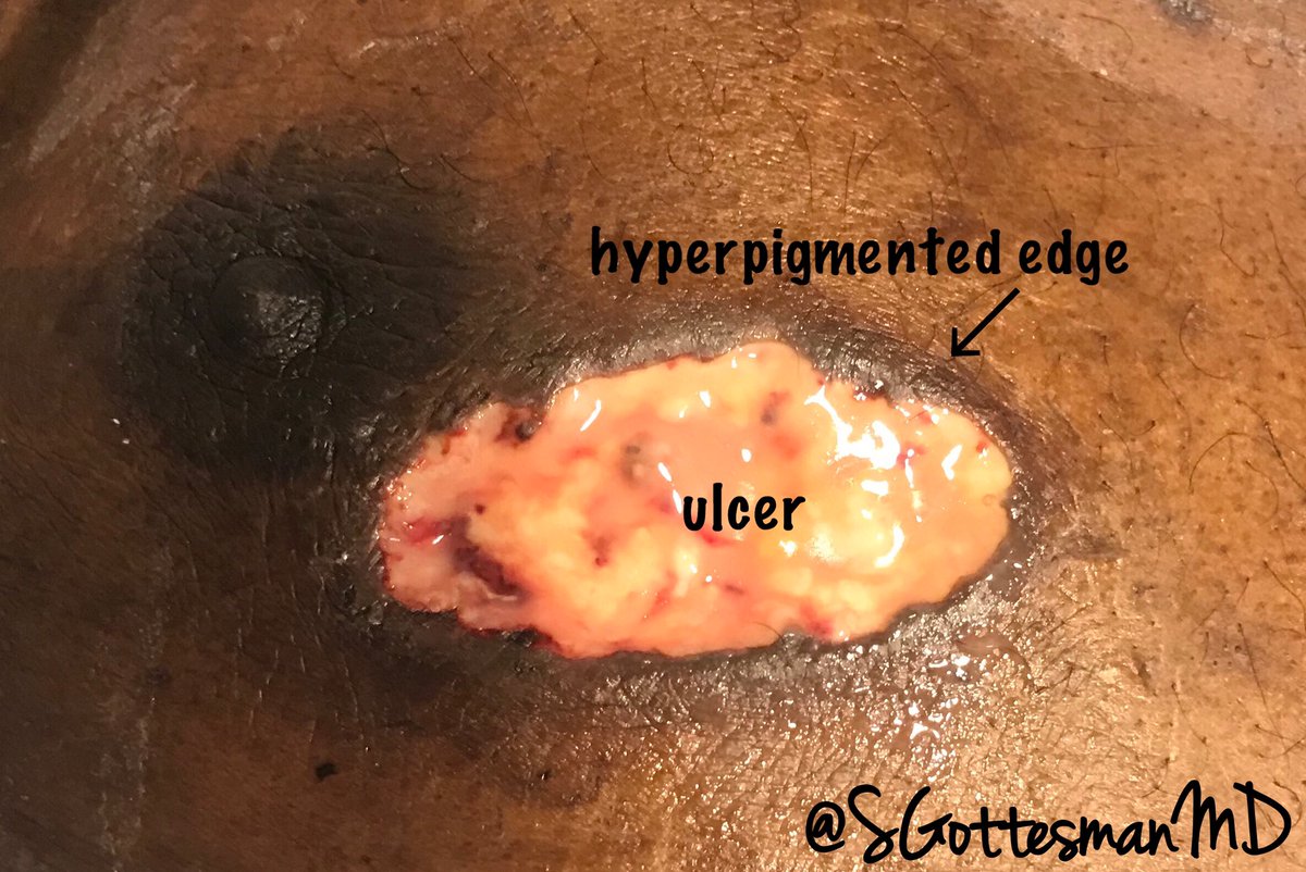 SGottesmanMD's tweet image. Pyoderma Gangrenosum
-Pustules that progress to Painful ulcers
-Rolled violaceous or hyperpigmented borders
Pathergy -fascinating phenomenon (dermal injury, from PIV 3rd pic)
Dx of exclusion: special stains, tissue cultures &amp;amp; deepers to exclude other causes
#dermpath #SilviPearls