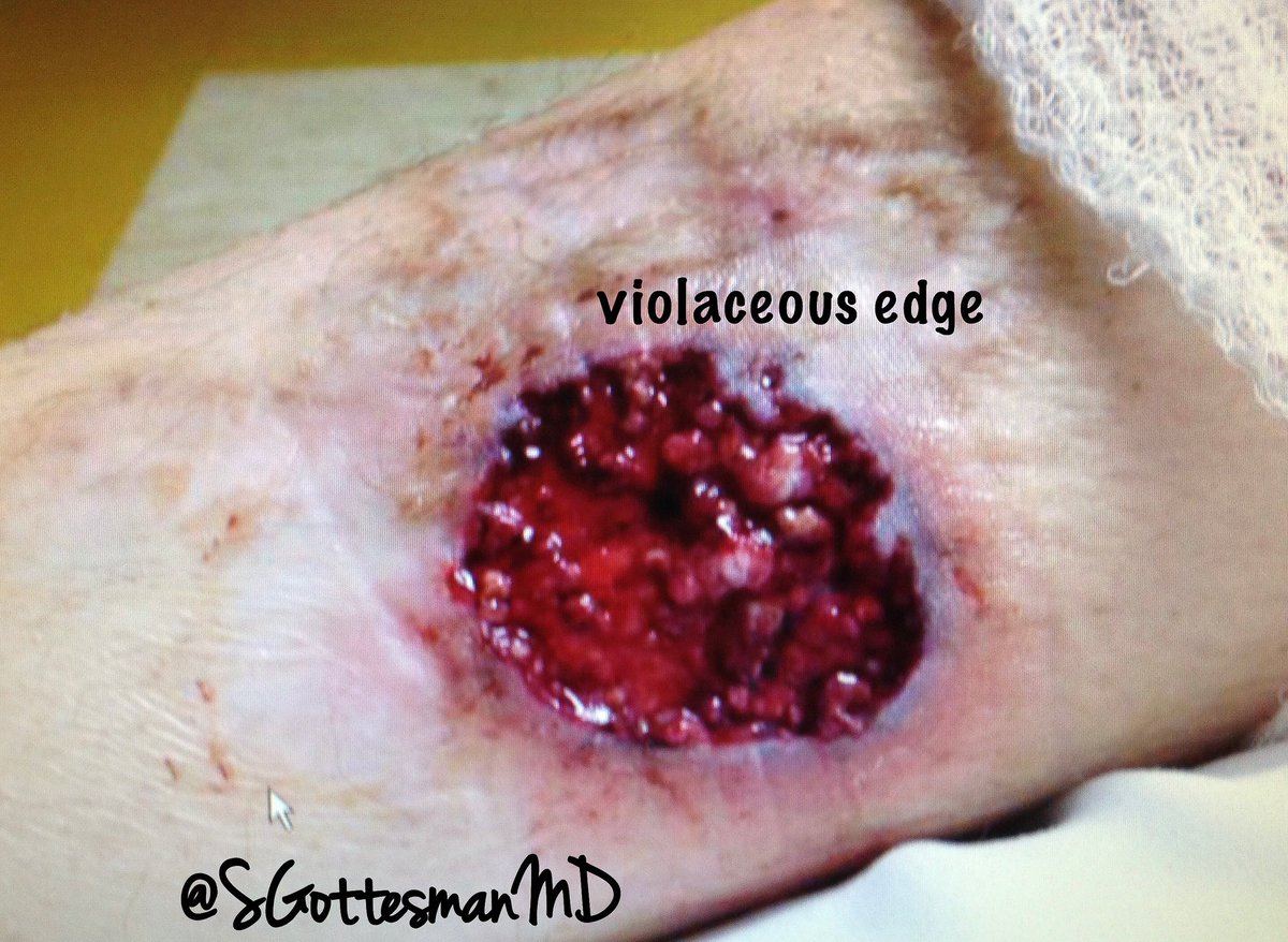 SGottesmanMD's tweet image. Pyoderma Gangrenosum
-Pustules that progress to Painful ulcers
-Rolled violaceous or hyperpigmented borders
Pathergy -fascinating phenomenon (dermal injury, from PIV 3rd pic)
Dx of exclusion: special stains, tissue cultures &amp;amp; deepers to exclude other causes
#dermpath #SilviPearls