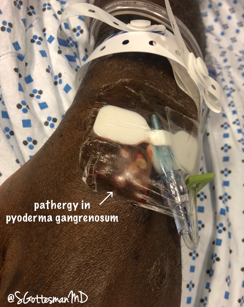 SGottesmanMD's tweet image. Pyoderma Gangrenosum
-Pustules that progress to Painful ulcers
-Rolled violaceous or hyperpigmented borders
Pathergy -fascinating phenomenon (dermal injury, from PIV 3rd pic)
Dx of exclusion: special stains, tissue cultures &amp;amp; deepers to exclude other causes
#dermpath #SilviPearls