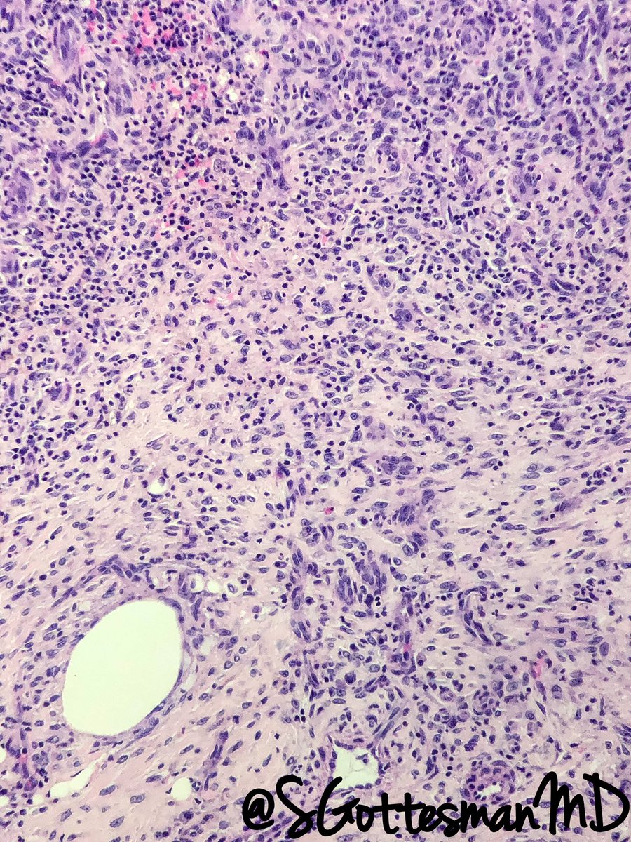 SGottesmanMD's tweet image. Pyoderma Gangrenosum
-Pustules that progress to Painful ulcers
-Rolled violaceous or hyperpigmented borders
Pathergy -fascinating phenomenon (dermal injury, from PIV 3rd pic)
Dx of exclusion: special stains, tissue cultures &amp;amp; deepers to exclude other causes
#dermpath #SilviPearls