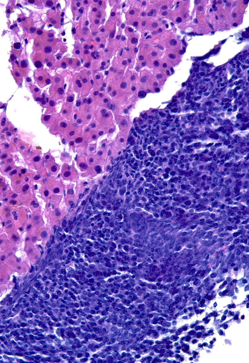 sza_jhcyto's tweet photo. “Good vs Bad” - “Pink vs Blue”. Liver FNA (cell block) with metastatic “Neuroendocrine Carcinoma”. https://t.co/93D672UTkE