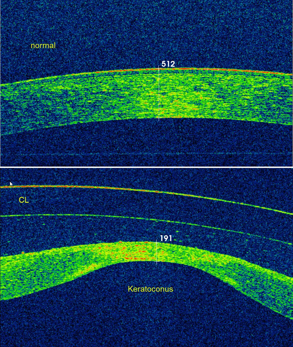 MalocaPeter's tweet photo. Cross sectional OCT display of #Keratoconus #3DOCT #Retinopsy @IOB_ch (top normal, below Keratoconus) https://t.co/DKKHInPSU9