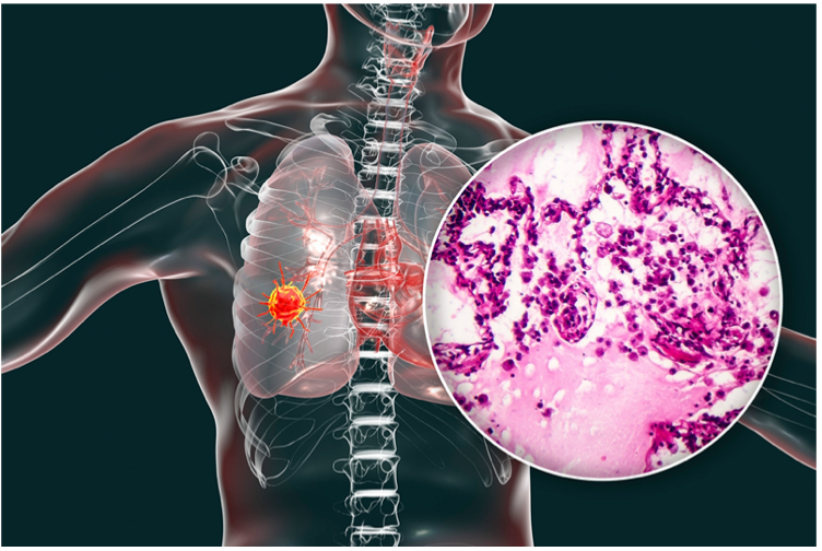 CancerFreeSC's tweet image. The American Cancer Society’s estimates for lung cancer in the United States for 2020 are:

About 228,820 new cases of lung cancer (116,300 in men and 112,520 in women)
About 135,720 deaths from lung cancer (72,500 in men and 63,220 in women)