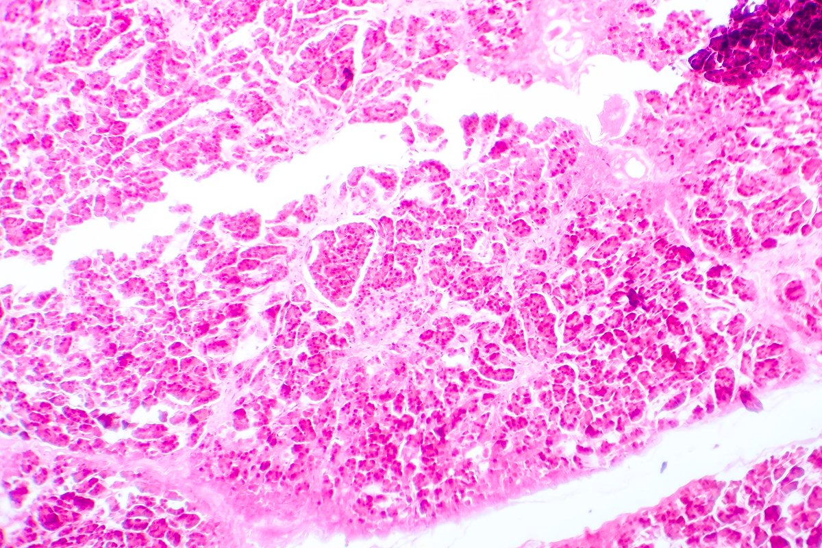 FollowMercy's tweet photo. Pancreatic cancer has the lowest survival rate of all major cancers. We want to change that. If you're interested in any of our current research trials (visit https://t.co/Q5w9I0s4R6), contact us at mercyresearchinfo@mercy.net. #PancreaticCancerAwarenessMonth https://t.co/GP87kCJlZq