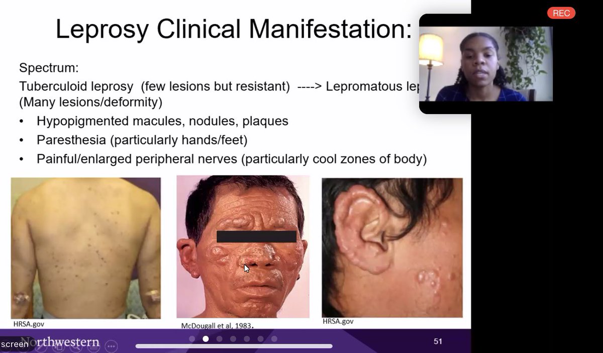 KateLima_'s tweet photo. Incredible CPC journey through a case of Hansen’s disease masquerading as R.P- new framework for thinking through ear pain and swelling! Expected nothing less from @kamariJackMD @NU_IntMed https://t.co/jeUEuWLKE9