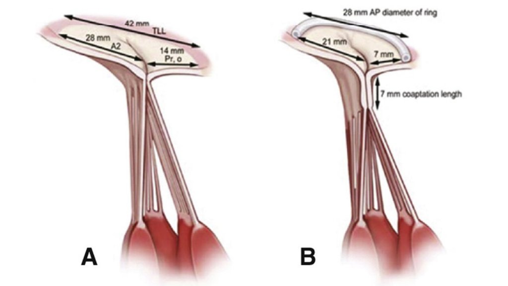 NMCardioVasc's tweet image. Patrick McCarthy, MD, &amp;amp; others wrote an article for @AATSHQ finding that degenerative #MitralRegurgitation repair using a measured algorithm could increase the precision &amp;amp; reproducibility of repair outcomes. See more: ms.spr.ly/6014pJrLK.
