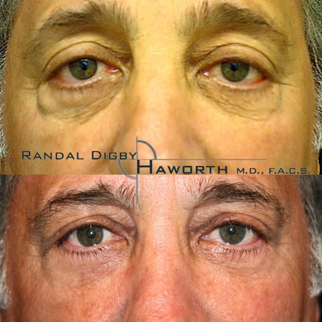 This patient not only had eyelids w/ crepey wrinkled skin, protruding bags &amp; dark hollowed  #teartroughs, but also had a sad, drooping appearance. 8 mos after canthoplasty (to elevate the lower eyelids), #blepharoplasty &amp; #fattransfer. #DrHaworth 

🌐DrHaworth.com