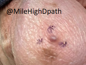 MileHighDpath's tweet photo. 75 year old man. Lesion on glans. O/w healthy.  Small purple papule. If you can have only one stain, which do you want next? 
A. CD31
B. CD34
C. D2-40
D. HHV8
E. S100
#Dermpathquiz #Dermquiz #DermpathCPC https://t.co/flS8vMAatR