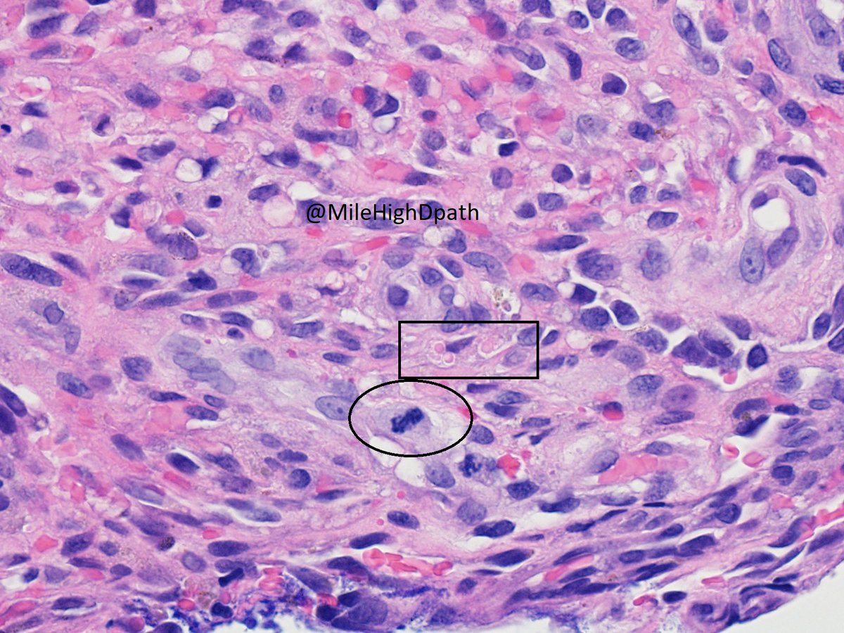 MileHighDpath's tweet photo. 75 year old man. Lesion on glans. O/w healthy.  Small purple papule. If you can have only one stain, which do you want next? 
A. CD31
B. CD34
C. D2-40
D. HHV8
E. S100
#Dermpathquiz #Dermquiz #DermpathCPC https://t.co/flS8vMAatR