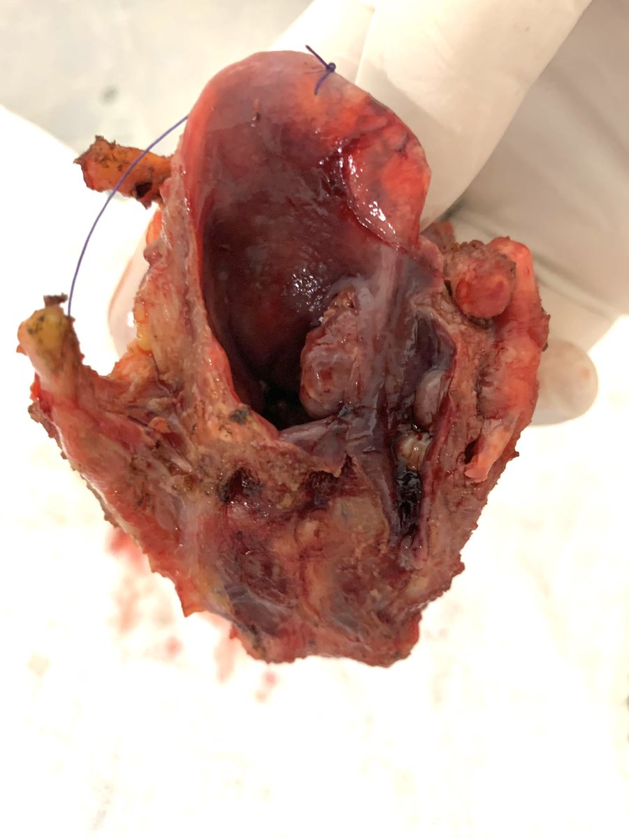 Laringectomia total por Ca de laringe recidivante postRT. Reconstrucción con colgajo supraclavicular. <a href="/futuroscirascol/">Future Surgeons</a> <a href="/ascolcirugia/">AsColCirugía</a> <a href="/alvarosanabria/">cirujano de cuello</a> @Cirbosque #SoMe4Surgery #SoMe4Headneck