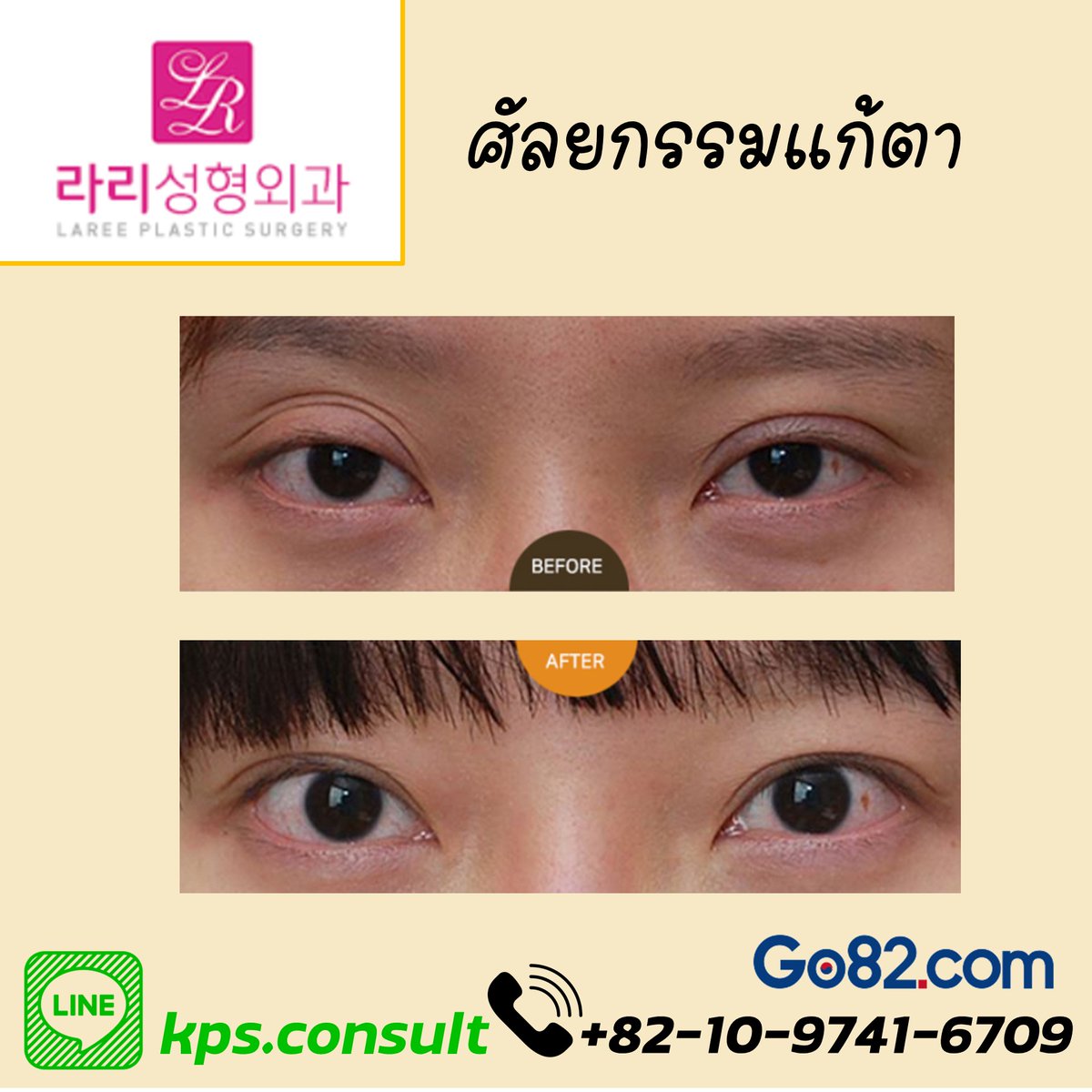 Go82Th's tweet image. ✨ศัลยกรรมเเก้ไขตา
มาเเก้ไขตากันได้ที่นี่ 
ใครที่ ศัลยกรรมตาเเล้วไม่พอใจอยากจะเเก้ไข
เข้ามาสอบถามได้เลยจร้า❗❗❗❗

#โมเดลศัลยกรรม #ศัลยกรรม #ศัลยกรรมเกาหลี #ศัลยกรรมความงาม #ศัลยกรรมพลิกชีวิต #เเนะนำ #ปรึกษา #ปรึกษาฟรี #ปรึกษาศัลยกรรม #โรงพยาบาล #โรงพยาบาลเกาหลี #ใบหน้า