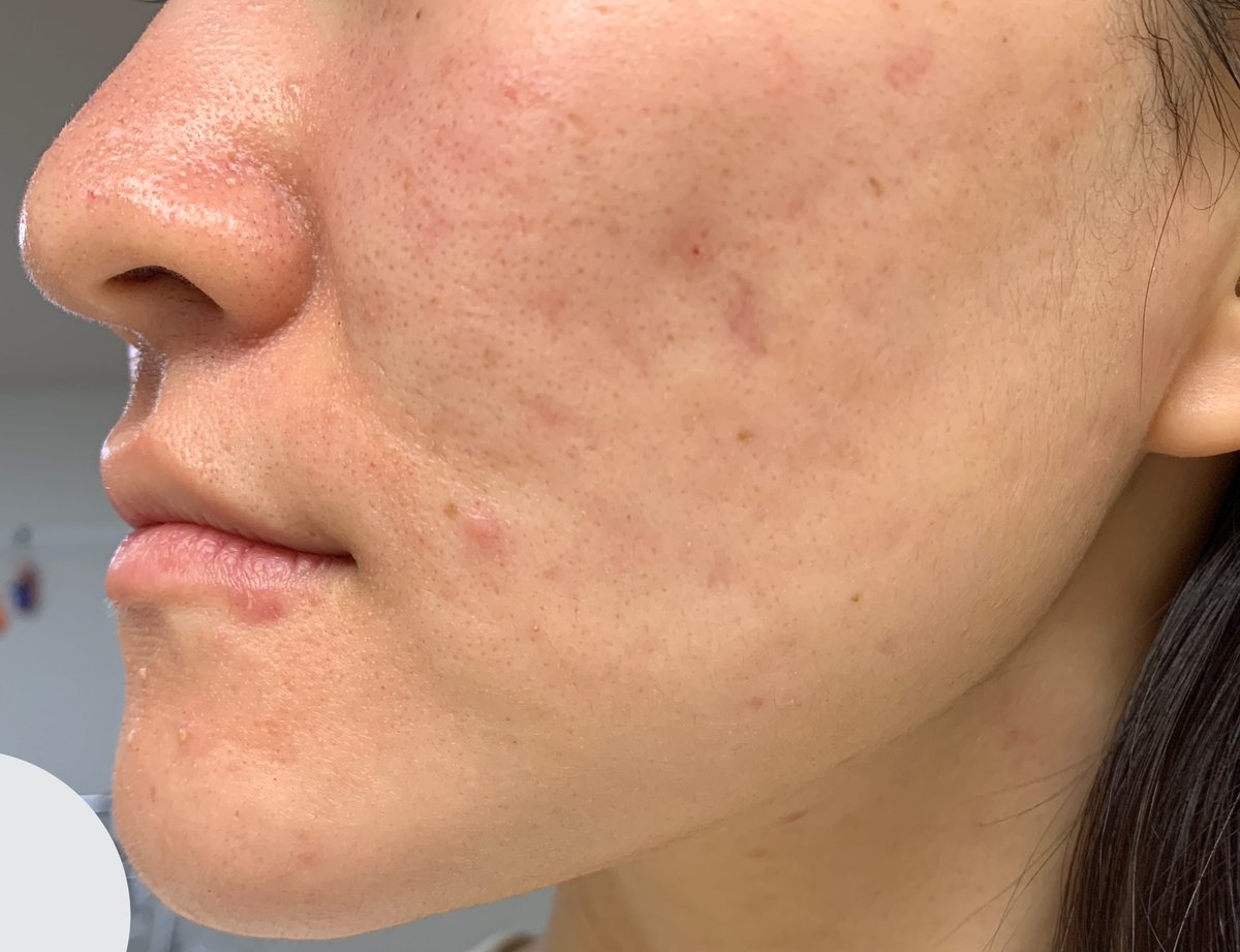 ニキビ治療日記はちみつ 赤みが思ってたほどない 水洗顔も無痛だったからこれ大丈夫 効果なかった ってなったけど その後のスキンケアが結構しみた バーコード状の点々が白くなってるのは鼻周りだけだし 額なんて全く普通な感じなんだけど