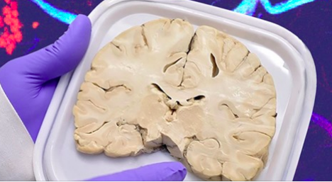 fciencias's tweet photo. Para estudiar las enfermedades neurodegenerativas, con frecuencia asociadas al #envejecimiento @FESC_UNAM  favoreció el desarrollo del Biobanco Nacional de Demencias, primero en su tipo en México. 🧠👇👀  https://t.co/u3qQhZmeqi https://t.co/DBf0BiFXqU
