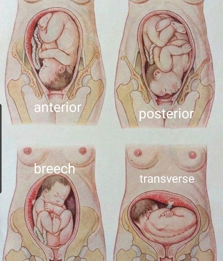 Medical Encyclopaedia on X different fetal positions in the womb. which baby position is best for normal delivery https t zQws4fX6Ni X