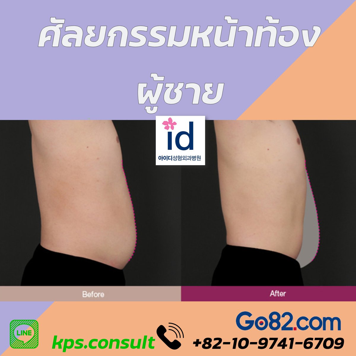 Go82Th's tweet image. ✨ศัลยกรรม SIX-PACK

เป็นศัลยกรรมดูดไขมันหน้าท้อง โดยไม่ต้องผ่าตัดสามารถโชว์หน้าท้องที่ดูเเน่น เเข็งเเรง ได้อย่างมั่นใจ👊🏻👊🏻👊🏻
สนใจติดต่อปรึกษาได้เลยจร้ส
#ศัลยกรรมเกาหลี #ศัยกรรม #ศัยกรรมหน้าท้อง #ศัลยกรรมผู้ชาย #ปรึกษาศัลยกรรม #เกาหลี #ผู้ชาย #ผู้ชายเกาหลี #อยาทำ #อยากศัลยกรรม