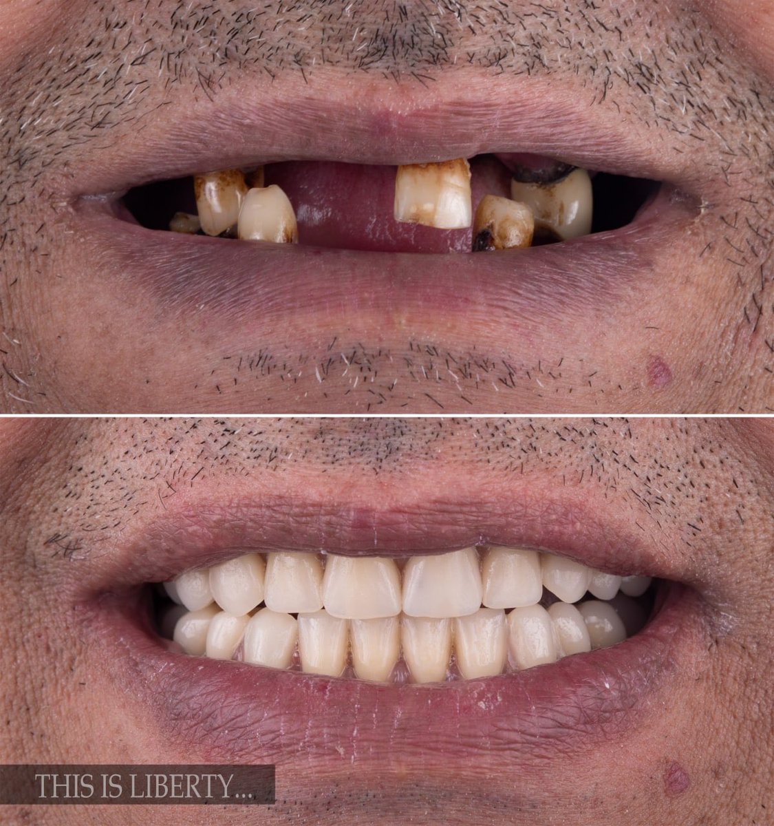Libertyclinic's tweet photo. انها ليبرتي يا سادة
مراجع لا يستطيع عمل زراعة
لعدة أسباب.. وهذه هي النتيجة
@libertydentalclinic https://t.co/F92Z1CSvBd