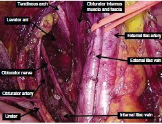 BJSurgery's tweet photo. In the BJS November issue: Rectal cancer lateral pelvic sidewall lymph nodes: a review of controversies and management https://t.co/jIe6iKmZ15 @AmyLightnerMD @bplwijn @des_winter @ksoreide @MalinASund @evanscolorectal @robhinchliffe1 @young_bjs https://t.co/LzWYZwToOm