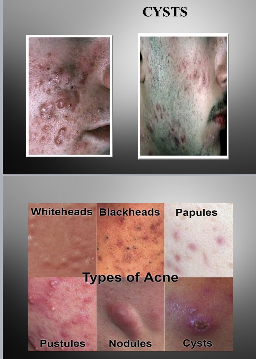 Inflammatory Acne- Papules, pustules, cyst, nodules•Causes-Genetics is the key factor when it comes to Acne even though there are diseases that can be associated with it.Other trigger factors; - Some medications can promote acne- cosmetic and pomades can block your pore