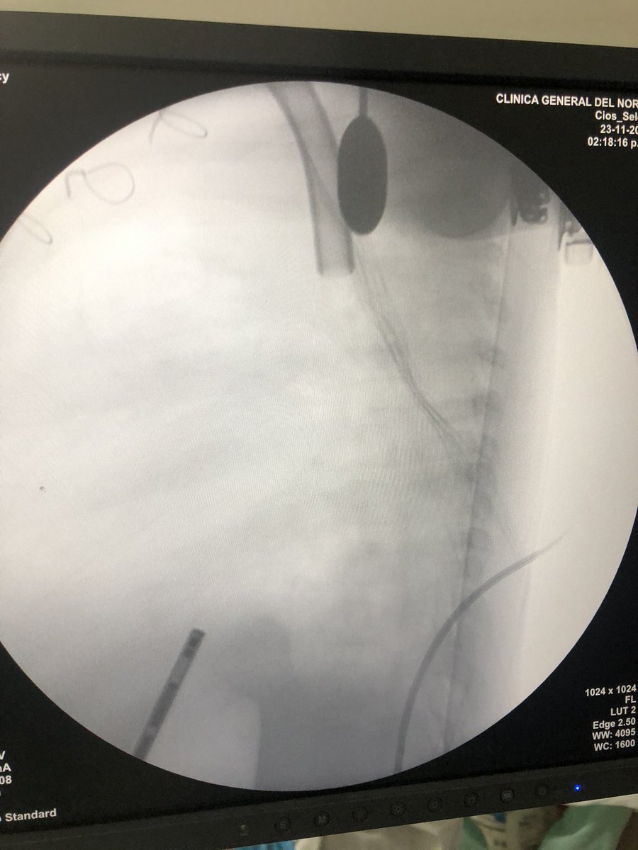 drabelloips's tweet photo. It’s possible that one baby with EA 1 or C don’t have any lower esophageal stump ? https://t.co/fKvIMRxXNL