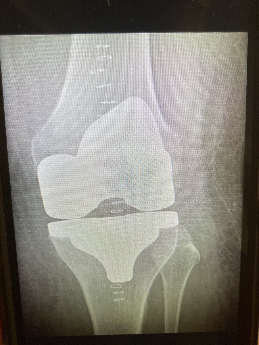 foodgrower's tweet photo. So here is my new #knee. The wonders of #science and #orthopeadicsurgery. The surgeon #mrgee and his team were great as were all the staff at #orpingtonhospital Thank you. Now home I’m going to get into my #exercise rountine. #kneereplacement #kneerehabilitation #physiotherapy https://t.co/fXW8Ot2AV9