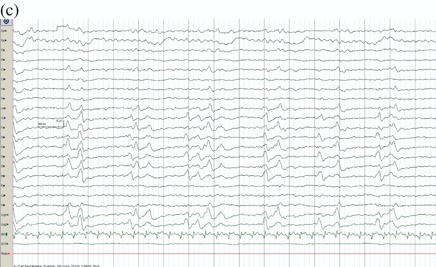 ClinicalNeuroph's tweet photo. [EEG glossary] Bilateral independent periodic discharges (BIPDs): BIPDs are 2 bilateral independent surface-negative bi- or di-, tri- or poly-phasic complexes consisting of spike components (https://t.co/eQBynTriVM).

Figure: https://t.co/cQIpUbZoCw
#BIPD #EEG #ClinicalNeuroph https://t.co/r8W59gMFkY