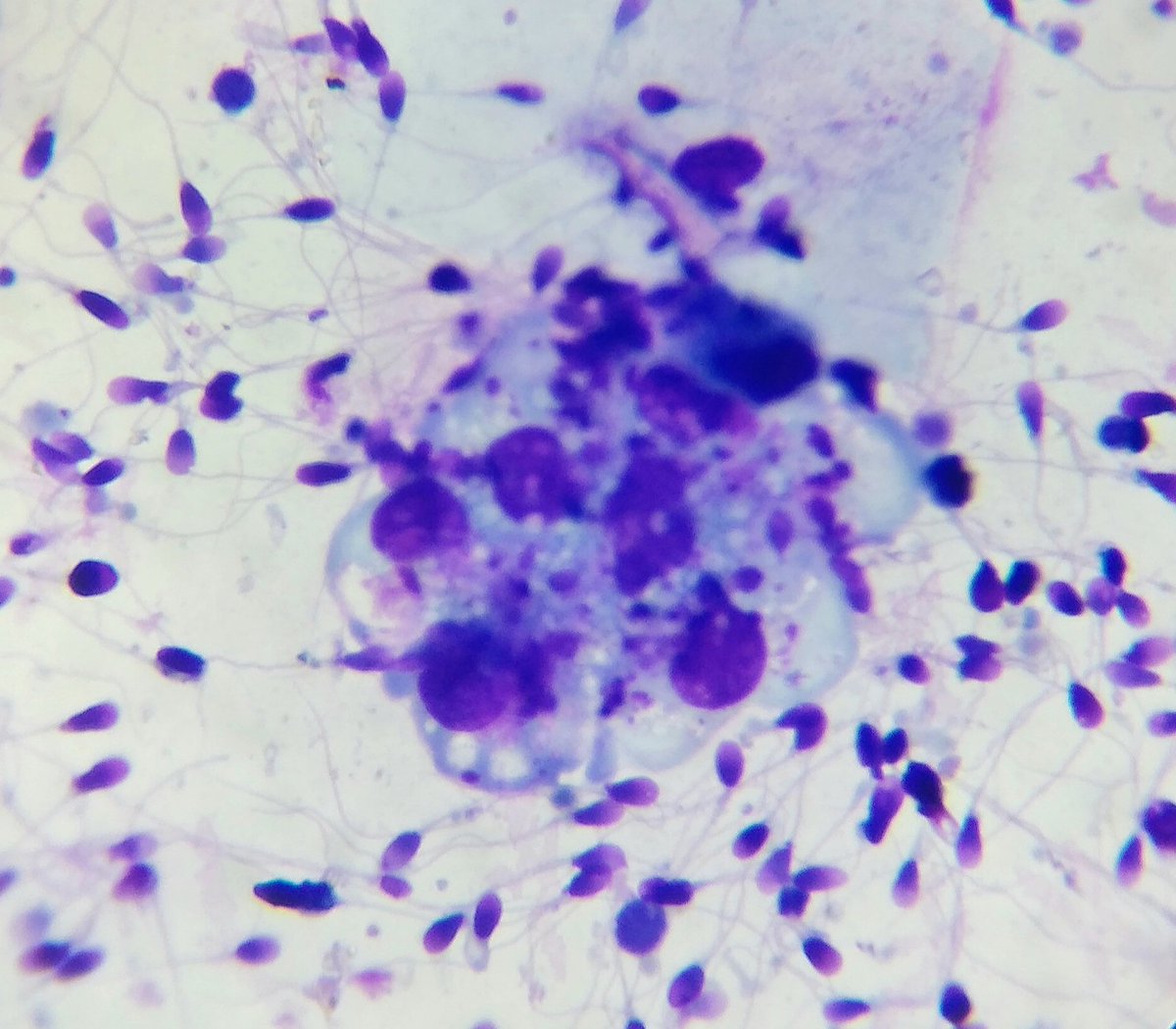 Lisaandrollab's tweet photo. Advanced Semen Analysis images. 
Sequence of #antisperm #phagocytosis in #semen from an #infertileman with positive #MARTEST. https://t.co/01ntdSWA5h