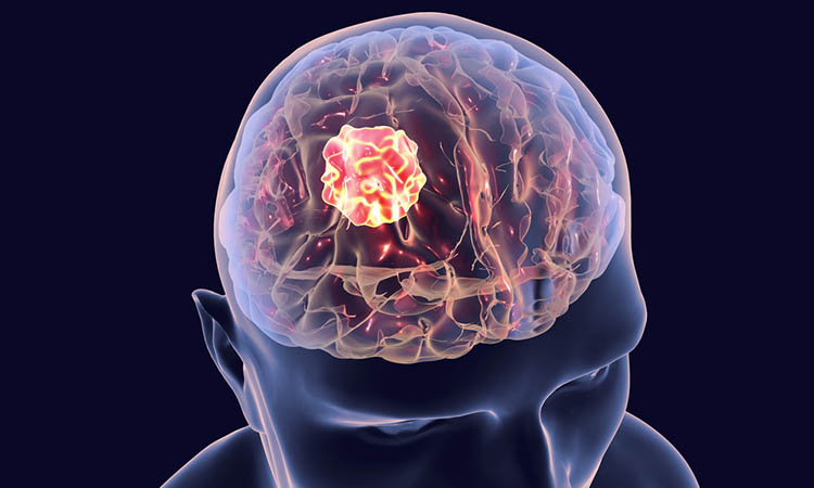 In pre-clinical studies, researchers at <a href="/mdandersonnews/">MD Anderson News</a> have shown that a new therapy called POMHEX can destroy #braincancer cells that were missing ENO1. 
#oncology #drugdiscovery
Read here: drugtargetreview.com/news/76791/nov…