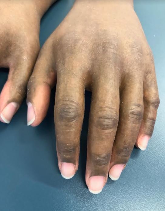 MedicalCenterOP's tweet photo. When we say we use high-definition silicone, we REALLY mean it!
#silicone #siliconehand #siliconehands #siliconeprosthetic #siliconeprosthetics #siliconeprosthesis #siliconeprostheses #prosthesis #prosthetist #amputeepride #moveforward #moveforwardMCOP #prosthetichand #oandp https://t.co/VlH3DHoyEV