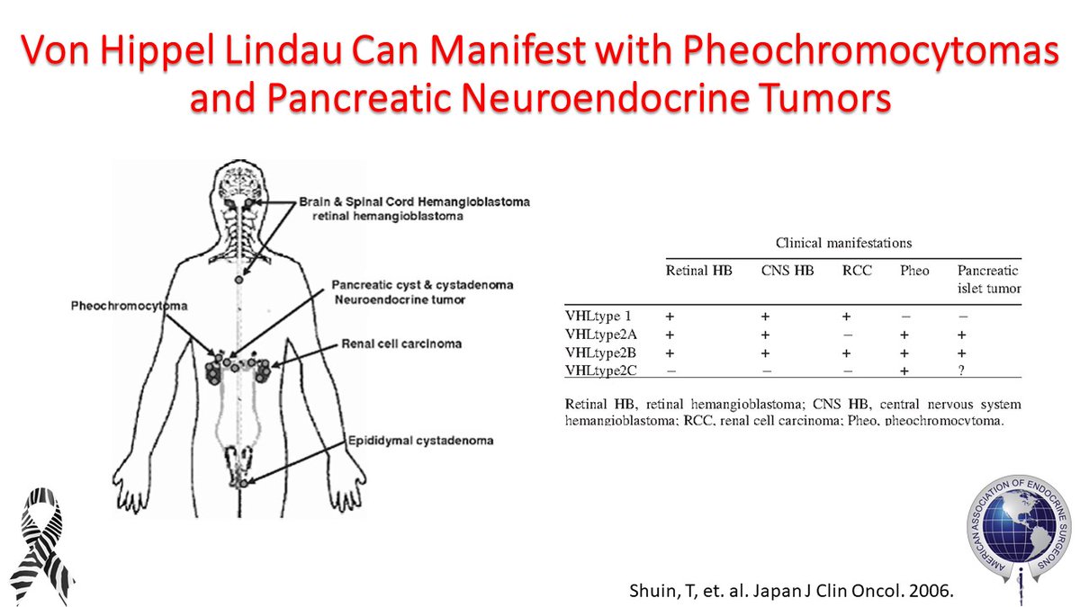 TheAAES's tweet photo. Common manifestations of Von Hippel Lindau (VHL) include pheochromocytomas and pancreatic neuroendocrine tumors. #NETAM2020 @VHLAlliance @AMEN_SUPPORT @CarcinoidNETs @NANETS1 @PheoPara https://t.co/uXRO7jbcM2