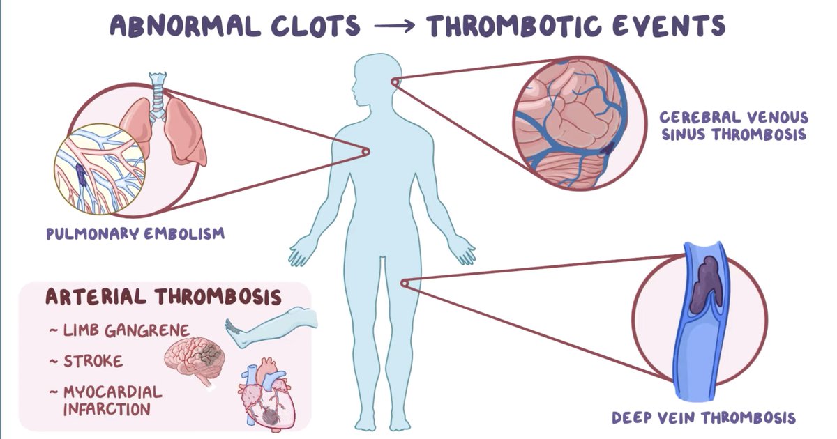 HIT (Heparin-induced thrombocytopenia), is classified under “ destruction”HIT in-depth:It is *common*, occurring in 1 out of 5,000 hospitalized patientsIt’s a can’t miss dx! 50% of patients w/ HIT who are not appropriately treated go on to develop a thrombosis