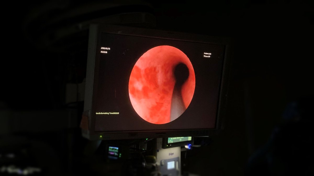 AMTsurgical's tweet photo. The trade off for single-use flex ureteroscopes has always been image quality & size...until now. The first site in Alberta to use the smaller #EUscope and see the 2.5 x better image for themselves are convinced. Thanks for the great review!
.
.
#AMTeuscope #Endourology #Canada https://t.co/LrTVImQPbC