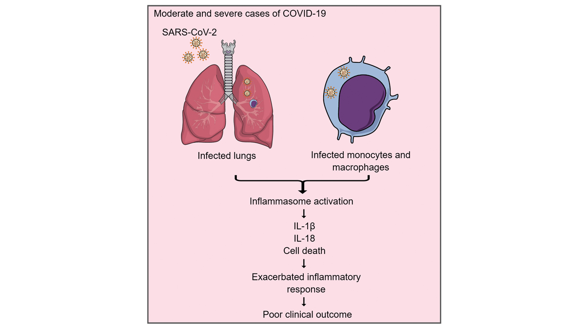 Journal of Experimental Medicine (@jexpmed) on Twitter photo Rodrigues, <a href="/ZamboniLab/">Dario S. Zamboni</a> et al. show that #inflammasomes are activated in response to #SARSCoV2 infection in vitro & in #COVID19 patients. #Inflammasome activation in moderate & severe cases of COVID-19 impacts disease progression & clinical outcome. bit.ly/2UZ4hXj Rodrigues, <a href="/ZamboniLab/">Dario S. Zamboni</a> et al. show that #inflammasomes are activated in response to #SARSCoV2 infection in vitro & in #COVID19 patients. #Inflammasome activation in moderate & severe cases of COVID-19 impacts disease progression & clinical outcome. bit.ly/2UZ4hXj