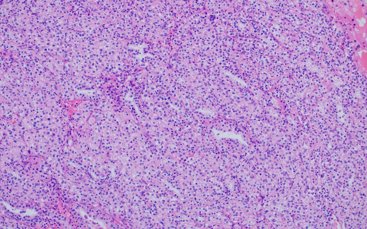 glom_busterMD's tweet photo. (1) Our paper on BAP1-mutated clear cell RCCs came out, so of course I had a case today! Think of BAP1 mutation in CCRCC with high grade, eosinophilic area with cytoplasmic granules/globlules adjacent to traditional component. https://t.co/0WXKFnyo5N https://t.co/yv2ATOaDEp