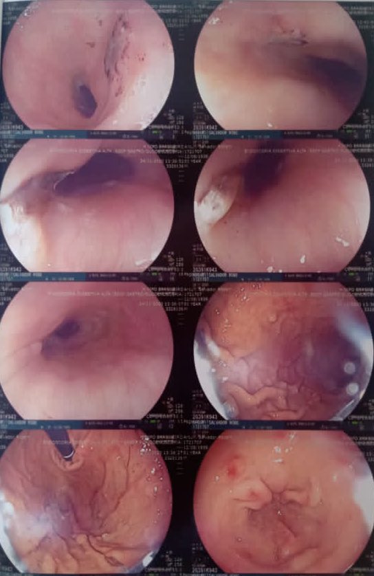 CarinaHardyEP (@carinahardy4) on Twitter photo #EPeeps PVI+PWI in AF Ps long duration. The esophagus was close to the right PV, temperature increased to 39.1 w/CIRCA. Endoscopy 24 h after ablation: ulcer 10 mm. surpoint 400 in WP
<a href="/Scanav1Mauricio/">Mauricio Scanavacca</a> <a href="/crpisani/">Cristiano Pisani</a> <a href="/MuhieddineC/">muhieddine chokr</a> <a href="/jtarr61/">Tarcisio Vasconcelos</a> <a href="/Dr_Santangeli/">Pasquale Santangeli</a> <a href="/aalahmadmd/">Amin Al-Ahmad, MD</a> #EPeeps PVI+PWI in AF Ps long duration. The esophagus was close to the right PV, temperature increased to 39.1 w/CIRCA. Endoscopy 24 h after ablation: ulcer 10 mm. surpoint 400 in WP
<a href="/Scanav1Mauricio/">Mauricio Scanavacca</a> <a href="/crpisani/">Cristiano Pisani</a> <a href="/MuhieddineC/">muhieddine chokr</a> <a href="/jtarr61/">Tarcisio Vasconcelos</a> <a href="/Dr_Santangeli/">Pasquale Santangeli</a> <a href="/aalahmadmd/">Amin Al-Ahmad, MD</a>