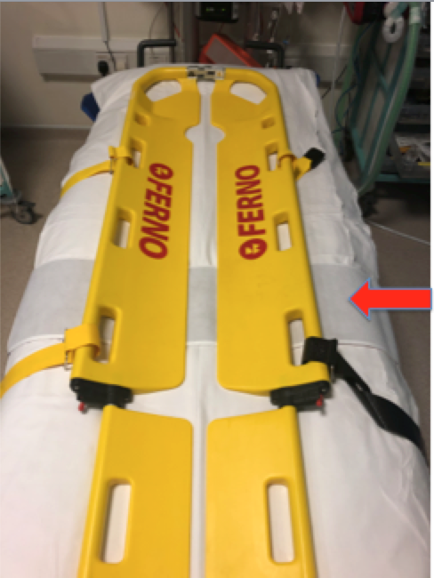 If a patient arrives without a binder who needs one (very rare) then we position the splint at the correct level on the ED trolley and lay the scoop stretcher/patient on top. When we remove the scoop stretcher we can then fasten the binder.