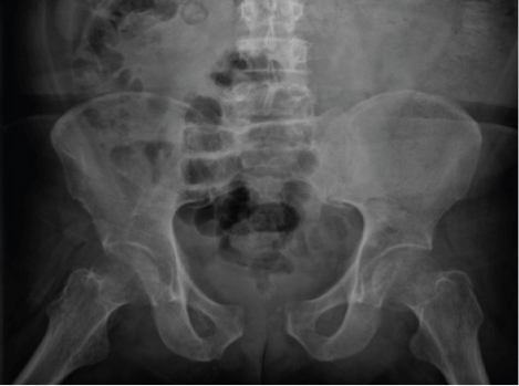 With a pelvic binder in situ, anatomical alignment may be restored on the CT leading to false reassurance. If CT = normal, but the pt has symptoms/signs of pelvic # or is unconscious, we routinely perform plain x-ray with the binder open to rule out an occult unstable fracture.