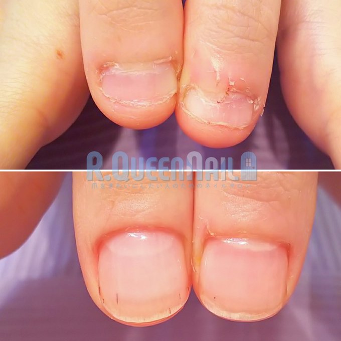 深爪ケアのtwitterイラスト検索結果