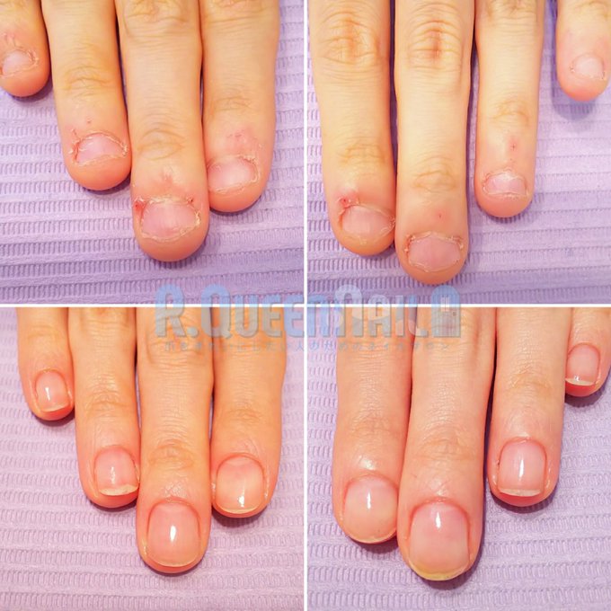 深爪ケアのtwitterイラスト検索結果