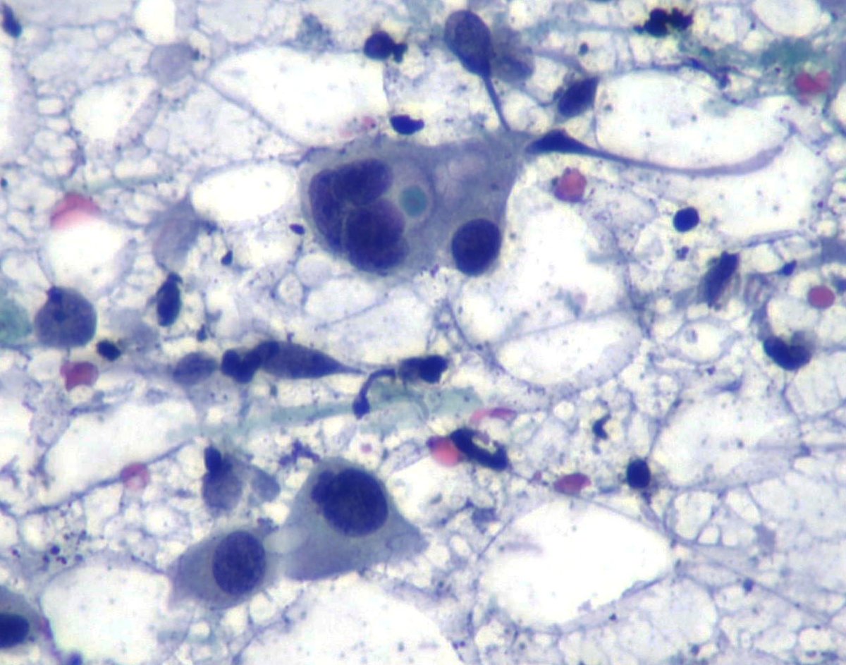 mdlozanoe's tweet photo. Nice Intracytoplasmic lumina.  Although more common in lobular carcinoma, this case is an infiltrating ductal carcinoma of the breast #CunPath #Cytopath #Pathresidents https://t.co/JBPUC9tHWp