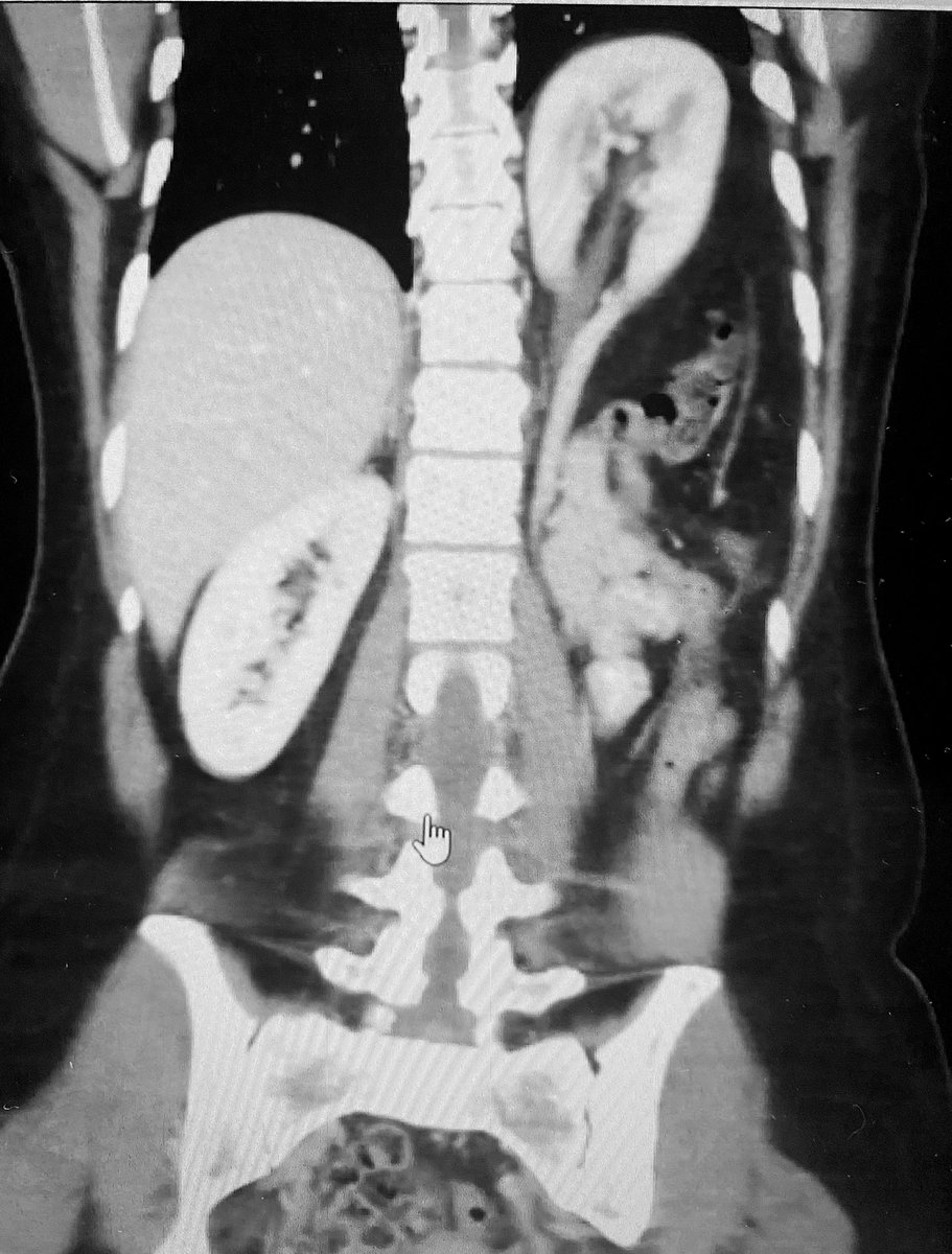 An interesting case of thoracic renal ectopia - herniation of kidney through foramen of Bochdalek  #MedTwitter #urology #radiology