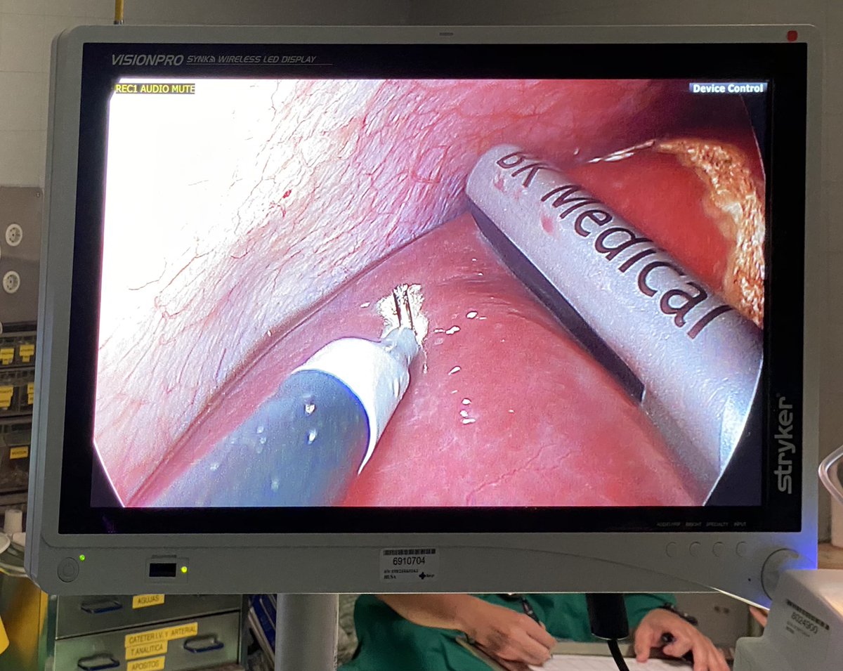 laparostato's tweet photo. Abordaje laparoscópico en una etapa de adenocarcinoma de sigma con metástasis hepatica única en segmento V. Gran trabajo 👏🏼👌🏼👨⚕️ @Curro_Blanco @JoseRoschow @trubiss @seccionhbpaec @AlbertoIsla1 @almagoch @cjGomez22 @aqxdemy @Cesar_Ginesta @aecformacion @FueyoA @sacyl https://t.co/VNkmoBp1M1