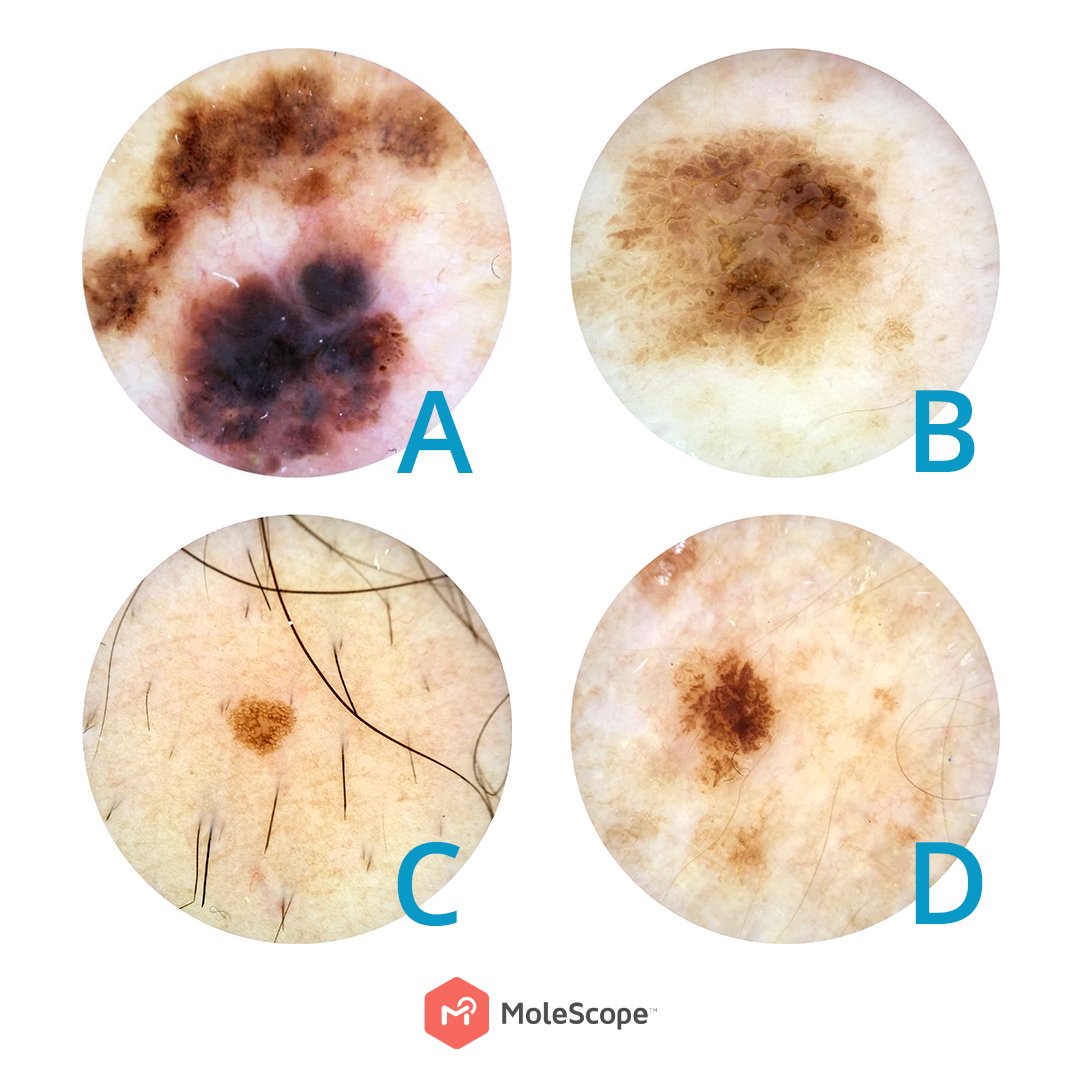 MoleScope's tweet image. Which of these spots is not like the other? Comment your guess below!

HINT: Use the ABCDE method
Asymmetry: do both halves match?
Border: are the spot's borders clear?
Colour- is it evenly coloured?
Diameter- is it less than 6mm?
Evolution- has it changed over time?