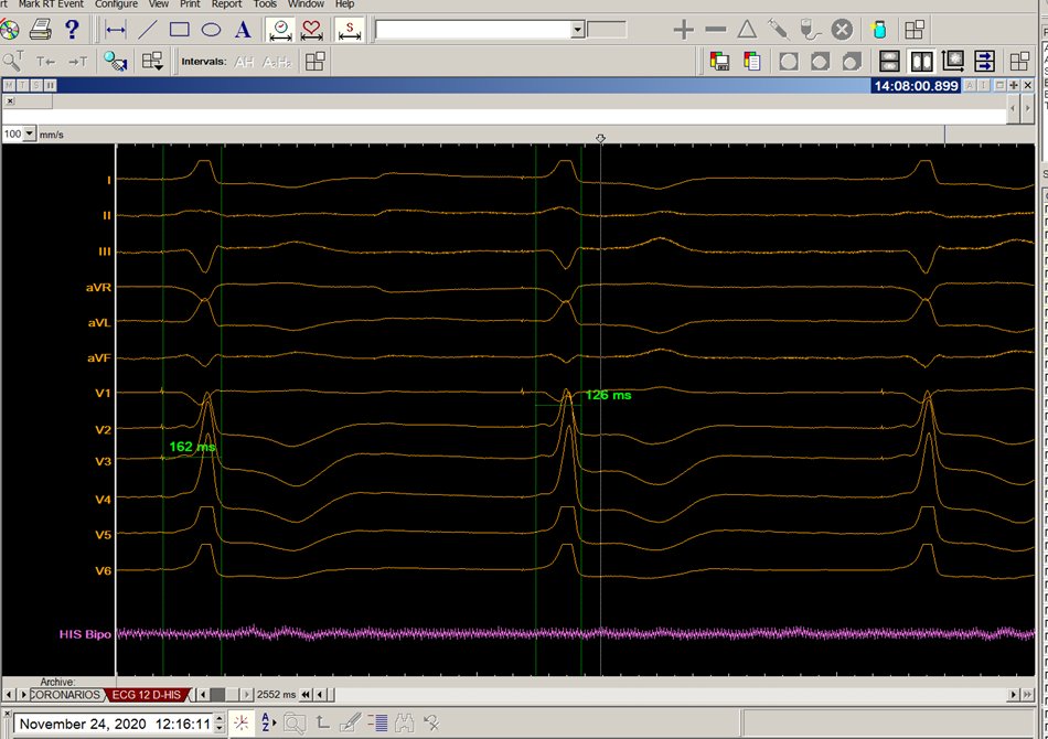 Third degree AV block. Pacemaker implantation with "left bundle branch stimulation". What is the final width of the paced QRS?. 126 vs 162 ms?  What is the correct way to measure it?